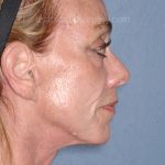 Upper & Lower Facelift - Brow Lift & Face/Neck Lift Before & After Patient #8304