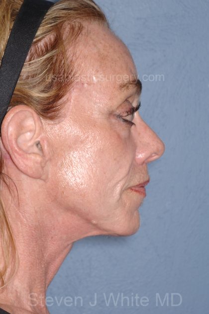 Upper & Lower Facelift - Brow Lift & Face/Neck Lift Before & After Patient #8304