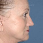 Upper & Lower Facelift - Brow Lift & Face/Neck Lift Before & After Patient #8305