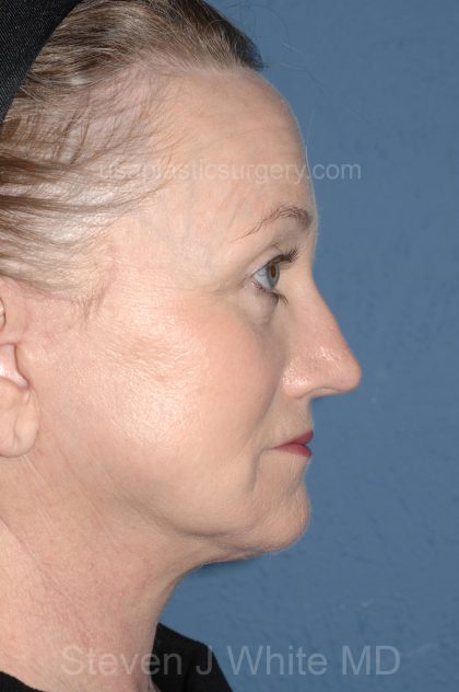 Upper & Lower Facelift - Brow Lift & Face/Neck Lift Before & After Patient #8305