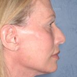 Upper & Lower Facelift - Brow Lift & Face/Neck Lift Before & After Patient #8026