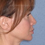Upper & Lower Facelift - Brow Lift & Face/Neck Lift Before & After Patient #8028
