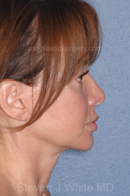Upper & Lower Facelift - Brow Lift & Face/Neck Lift Before & After Patient #8028