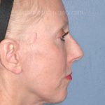 Upper & Lower Facelift - Brow Lift & Face/Neck Lift Before & After Patient #8029