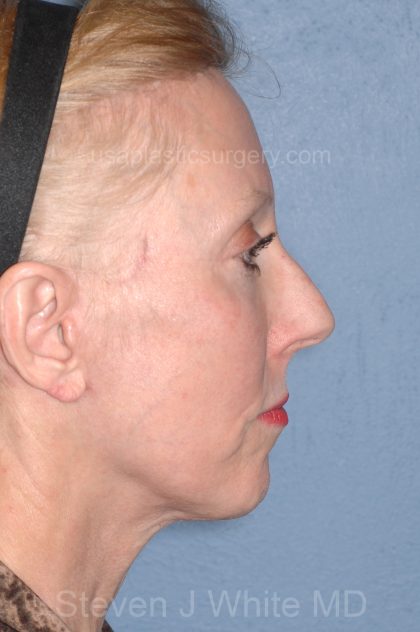 Upper & Lower Facelift - Brow Lift & Face/Neck Lift Before & After Patient #8029