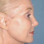 Upper & Lower Facelift - Brow Lift & Face/Neck Lift Before & After Patient #8030
