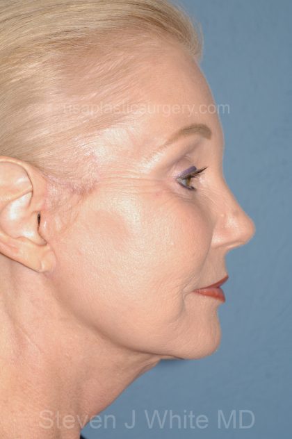 Upper & Lower Facelift - Brow Lift & Face/Neck Lift Before & After Patient #8030