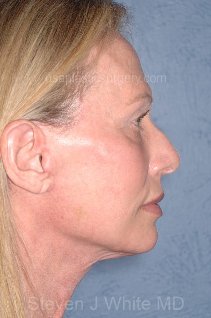 Upper & Lower Facelift - Brow Lift & Face/Neck Lift Before & After Patient #8026