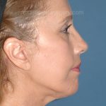 Upper & Lower Facelift - Brow Lift & Face/Neck Lift Before & After Patient #8031