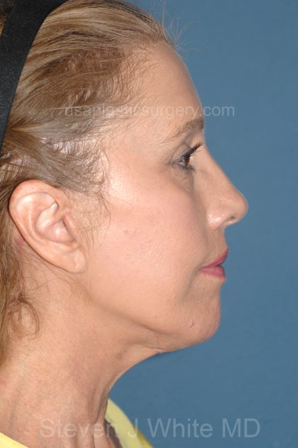 Upper & Lower Facelift - Brow Lift & Face/Neck Lift Before & After Patient #8031