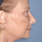Upper & Lower Facelift - Brow Lift & Face/Neck Lift Before & After Patient #8032