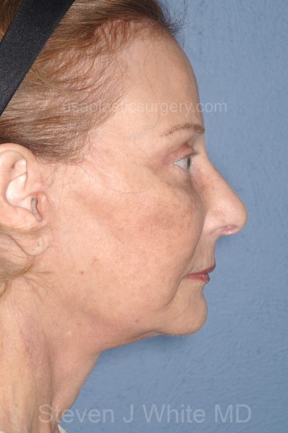 Upper & Lower Facelift - Brow Lift & Face/Neck Lift Before & After Patient #8032