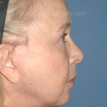 Upper & Lower Facelift - Brow Lift & Face/Neck Lift Before & After Patient #8034