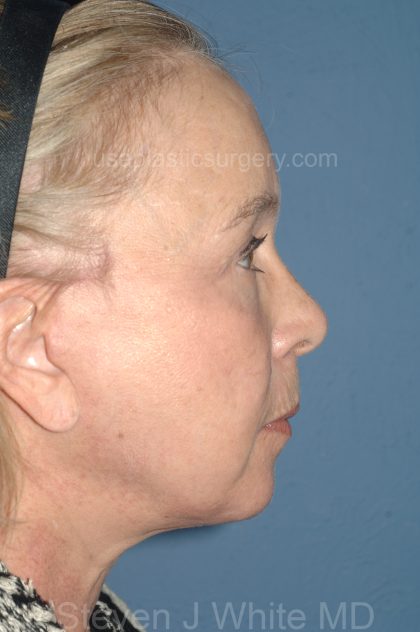 Upper & Lower Facelift - Brow Lift & Face/Neck Lift Before & After Patient #8034