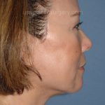 Upper & Lower Facelift - Brow Lift & Face/Neck Lift Before & After Patient #8033