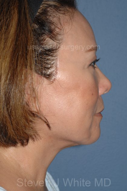 Upper & Lower Facelift - Brow Lift & Face/Neck Lift Before & After Patient #8033