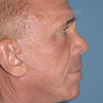 Upper & Lower Facelift - Brow Lift & Face/Neck Lift Before & After Patient #8035