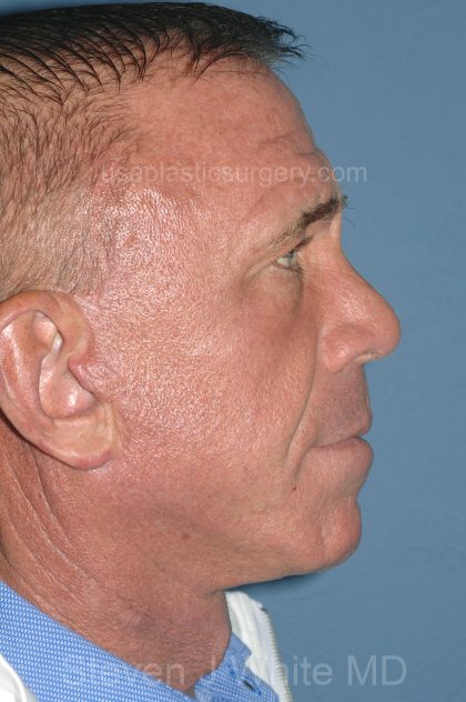 Upper & Lower Facelift - Brow Lift & Face/Neck Lift Before & After Patient #8035