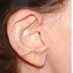 Facelift - Scar Before & After Patient #8173