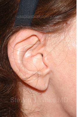 Facelift - Scar Before & After Patient #8173