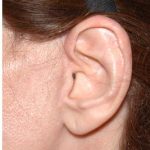 Facelift - Scar Before & After Patient #8173
