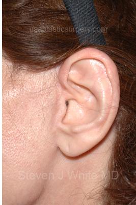 Facelift - Scar Before & After Patient #8173