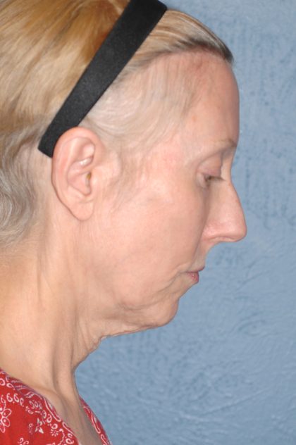 Upper & Lower Facelift - Brow Lift & Face/Neck Lift Before & After Patient #8029