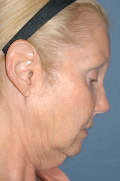 Upper & Lower Facelift - Brow Lift & Face/Neck Lift Before & After Patient #8030