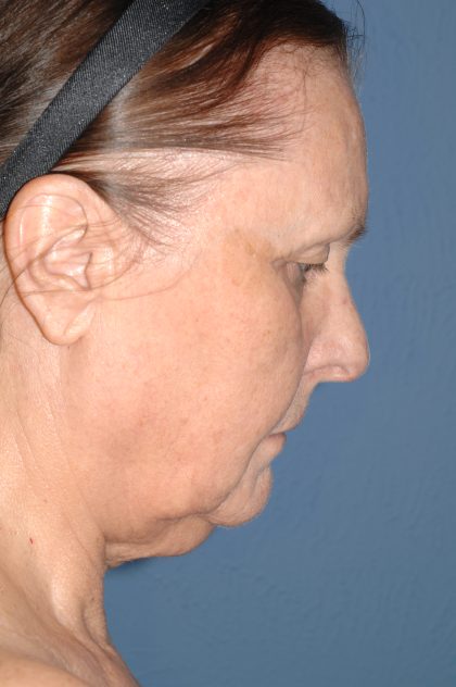Upper & Lower Facelift - Brow Lift & Face/Neck Lift Before & After Patient #8301