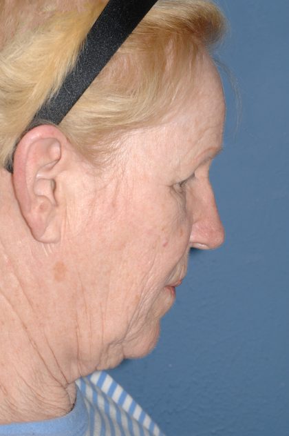 Upper & Lower Facelift - Brow Lift & Face/Neck Lift Before & After Patient #8303