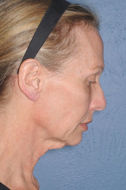 Upper & Lower Facelift - Brow Lift & Face/Neck Lift Before & After Patient #8026