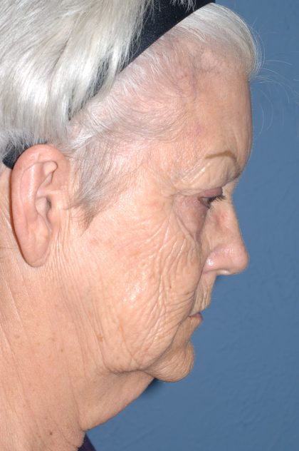 Upper & Lower Facelift - Brow Lift & Face/Neck Lift Before & After Patient #8302
