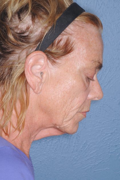 Upper & Lower Facelift - Brow Lift & Face/Neck Lift Before & After Patient #8304