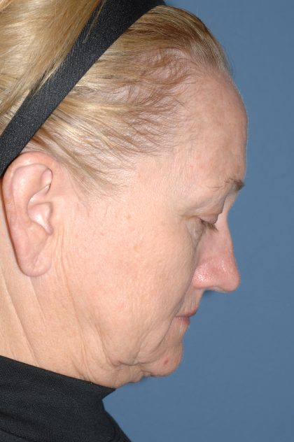 Upper & Lower Facelift - Brow Lift & Face/Neck Lift Before & After Patient #8305