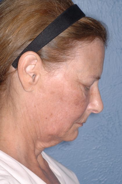 Upper & Lower Facelift - Brow Lift & Face/Neck Lift Before & After Patient #8032