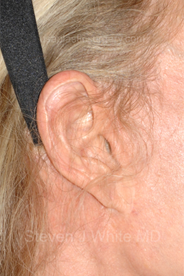 Upper & Lower Facelift - Brow Lift & Face/Neck Lift Before & After Patient #8027
