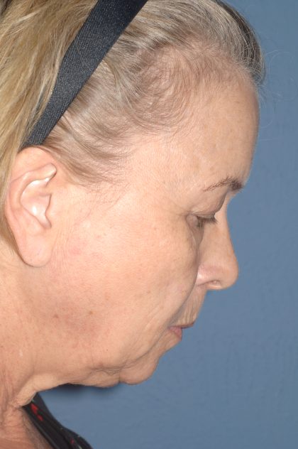 Upper & Lower Facelift - Brow Lift & Face/Neck Lift Before & After Patient #8034