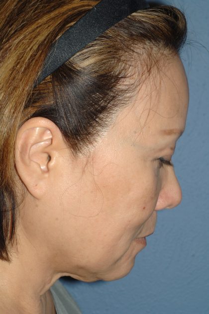 Upper & Lower Facelift - Brow Lift & Face/Neck Lift Before & After Patient #8033