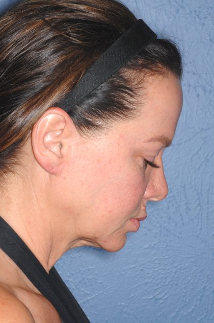 Upper & Lower Facelift - Brow Lift & Face/Neck Lift Before & After Patient #8028