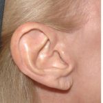 Facelift - Scar Before & After Patient #8174