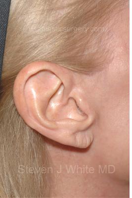 Facelift - Scar Before & After Patient #8174