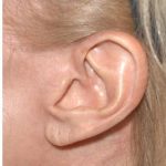 Facelift - Scar Before & After Patient #8174