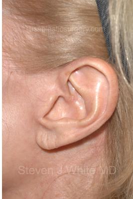 Facelift - Scar Before & After Patient #8174