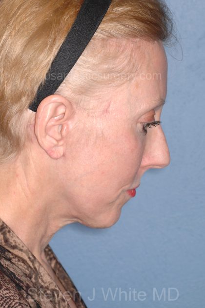 Upper & Lower Facelift - Brow Lift & Face/Neck Lift Before & After Patient #8029