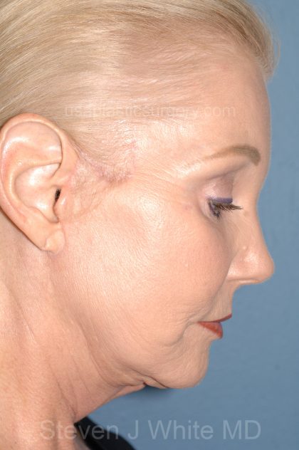 Upper & Lower Facelift - Brow Lift & Face/Neck Lift Before & After Patient #8030