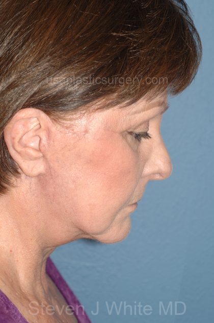 Upper & Lower Facelift - Brow Lift & Face/Neck Lift Before & After Patient #8301