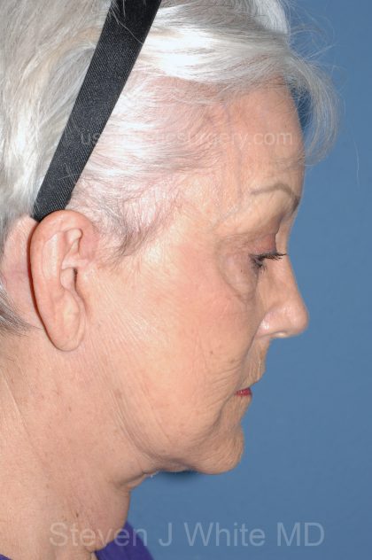 Upper & Lower Facelift - Brow Lift & Face/Neck Lift Before & After Patient #8302