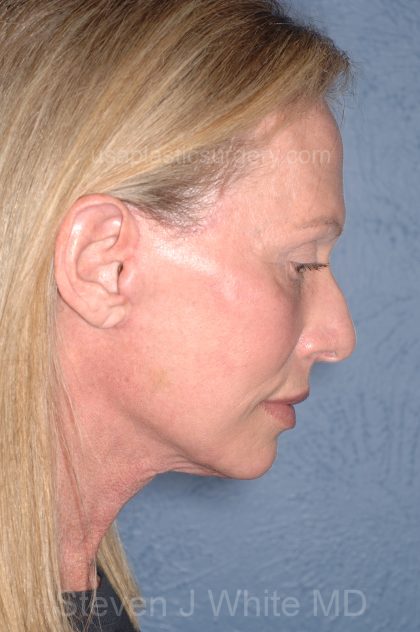 Upper & Lower Facelift - Brow Lift & Face/Neck Lift Before & After Patient #8026