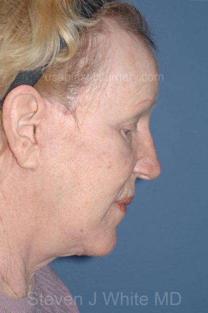 Upper & Lower Facelift - Brow Lift & Face/Neck Lift Before & After Patient #8303