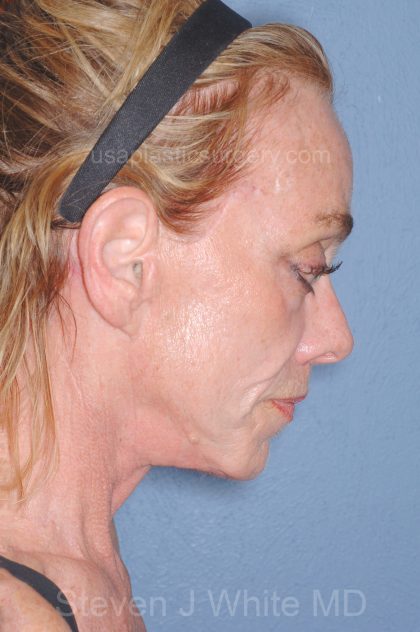 Upper & Lower Facelift - Brow Lift & Face/Neck Lift Before & After Patient #8304